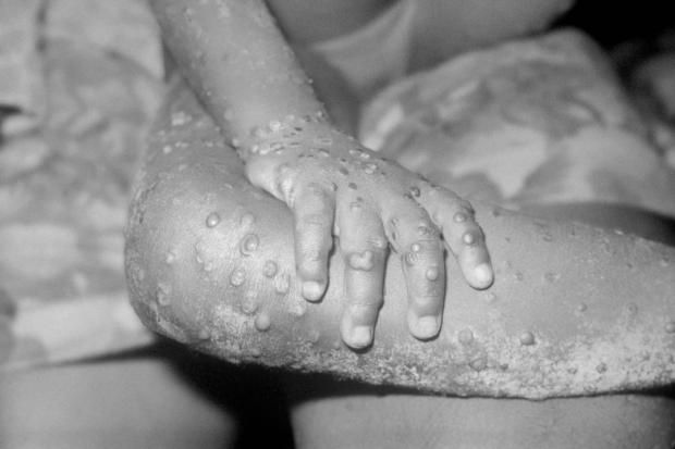 Chelmsford Weekly News: The monkeypox virus can be spread in a number of ways. Picture: PA